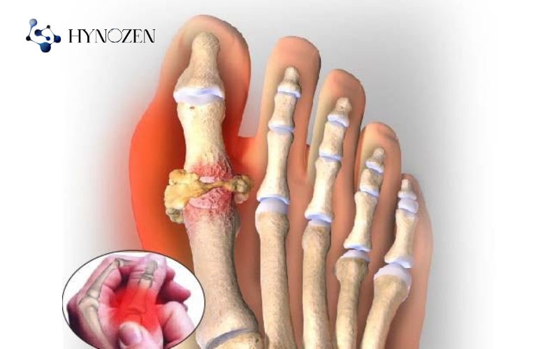 Bệnh gout là gì?